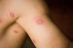 ringworm-scalp-2