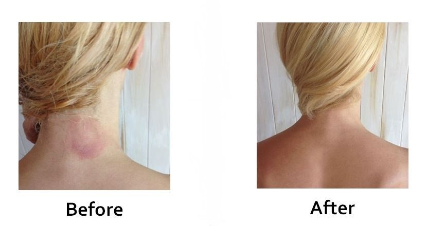 before and after pictures of puriya wonder balm phytozine before after