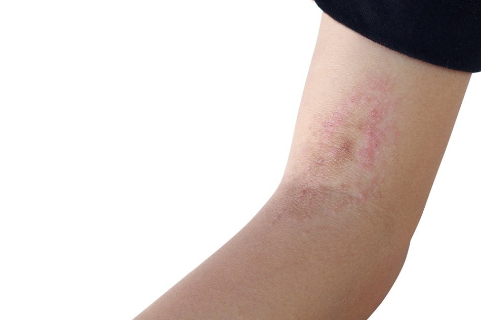 what is ringworm what is it