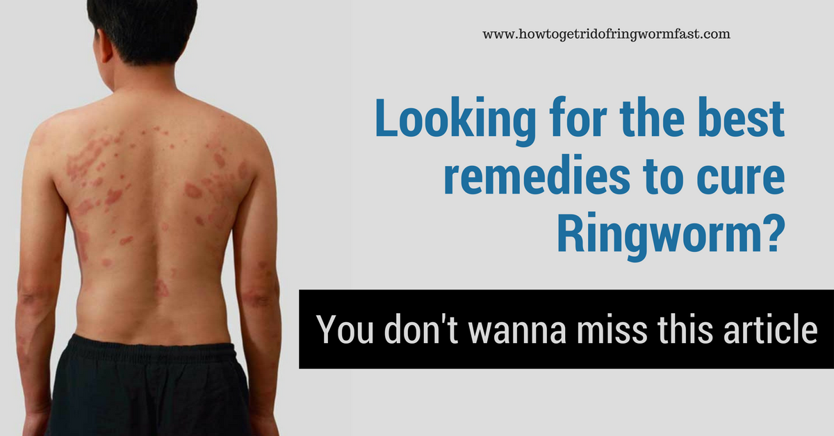 best remedies to cure Ringworm